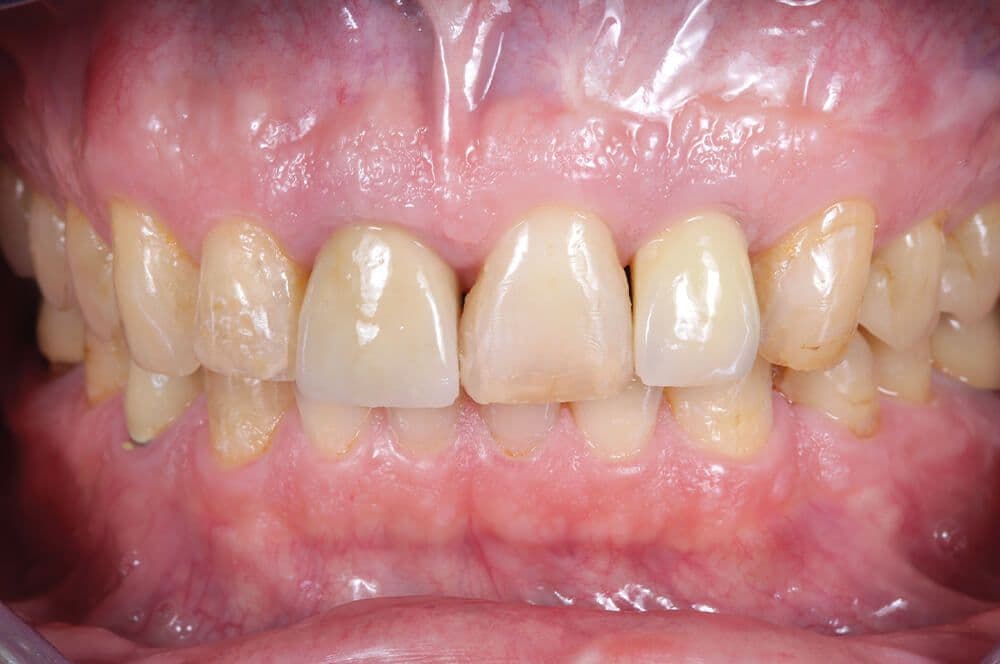 1. Ausgangssituation mit leichter Gingivitis an Zahn 11.