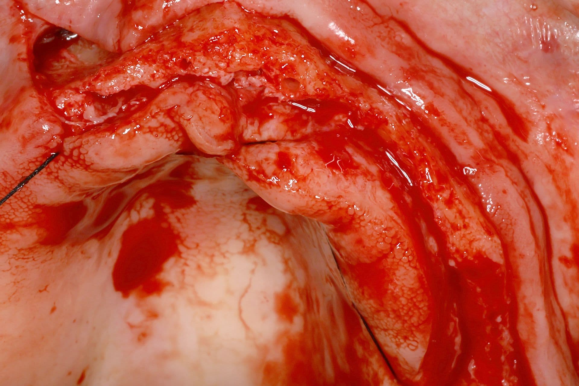Abbildung 14: Einsetzen von Implantaten mit 2,5 mm Durchmesser, gefolgt von einer Überkorrektur der Kieferkammbreite mit autologem Knochen, der durch Knochenpräparation gewonnen wurde (hauptsächlich aus dem Einsetzen von Implantaten im Unterkiefer), kombiniert mit PRGF-Endoret und einer dünnen Schicht Biomaterial (bovines Hydroxylapatit), das ebenfalls mit PRGF-Endoret eingebracht wurde.