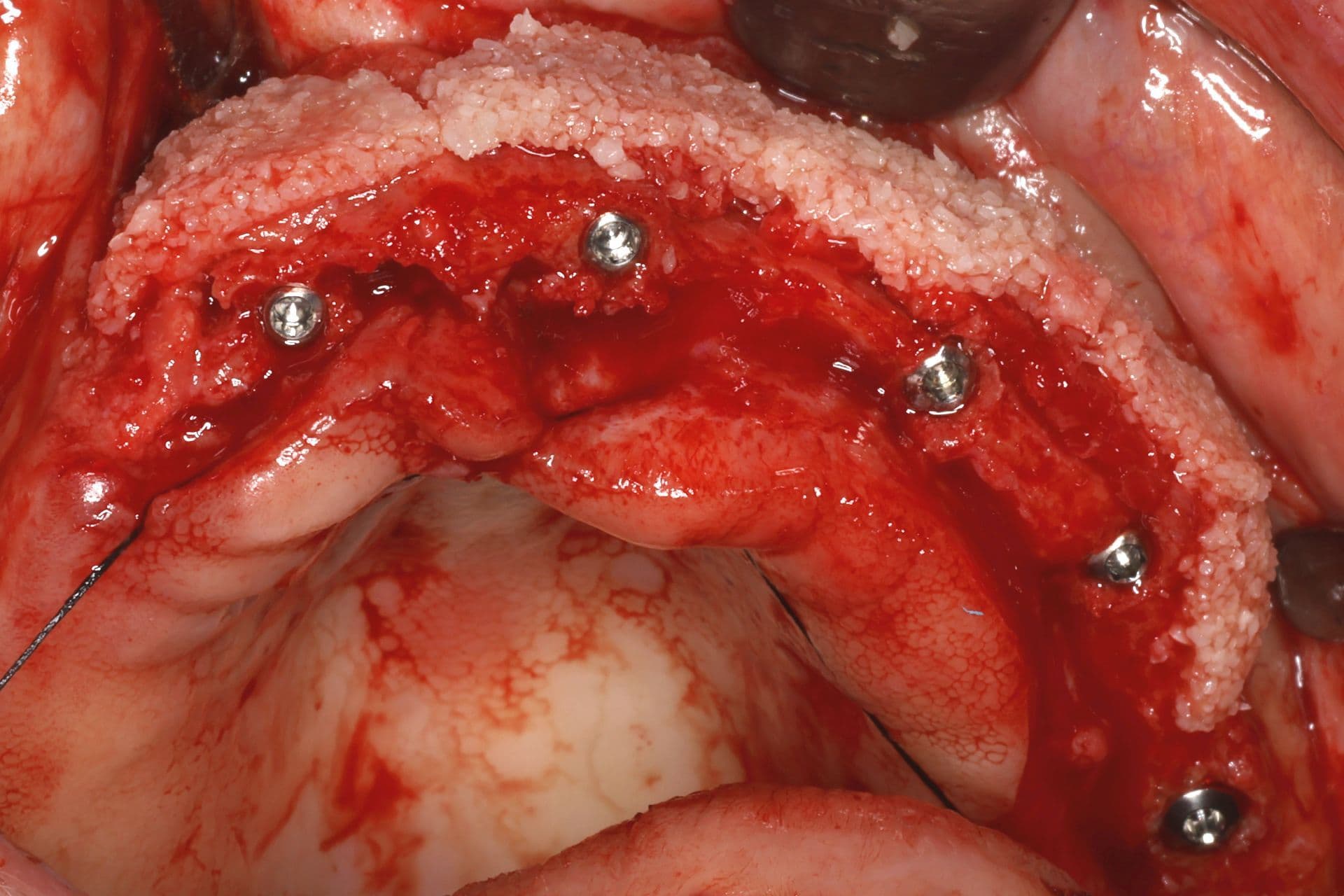 Abbildung 17: Einsetzen von Implantaten mit 2,5 mm Durchmesser, gefolgt von einer Überkorrektur der Kieferkammbreite mit autologem Knochen, der durch Knochenpräparation gewonnen wurde (hauptsächlich aus dem Einsetzen von Implantaten im Unterkiefer), kombiniert mit PRGF-Endoret und einer dünnen Schicht Biomaterial (bovines Hydroxylapatit), das ebenfalls mit PRGF-Endoret eingebracht wurde.