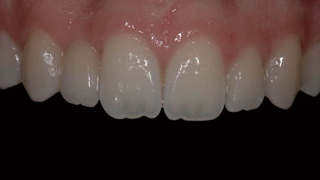 Cerec-Tag