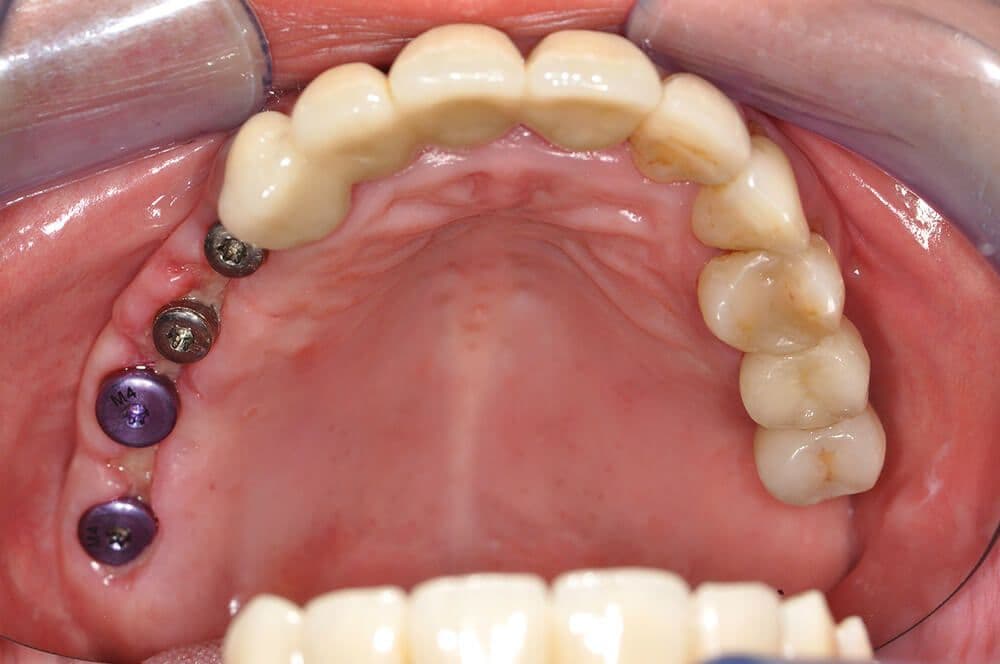 Ultrakurze Implantate im Molarenbereich