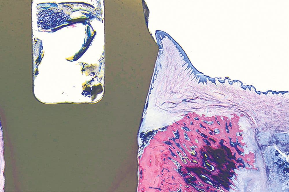 Periimplantitis