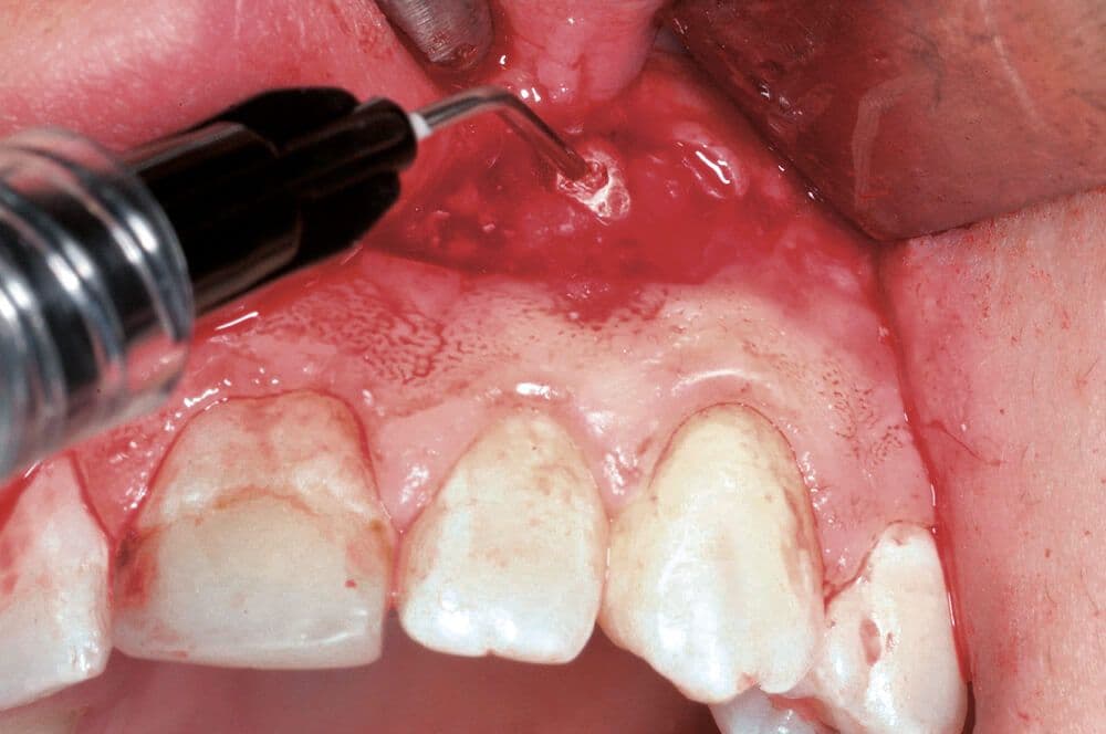 Abdeckung des Defektes zur Optimierung der Geweberegeneration mit Flex Barrier.