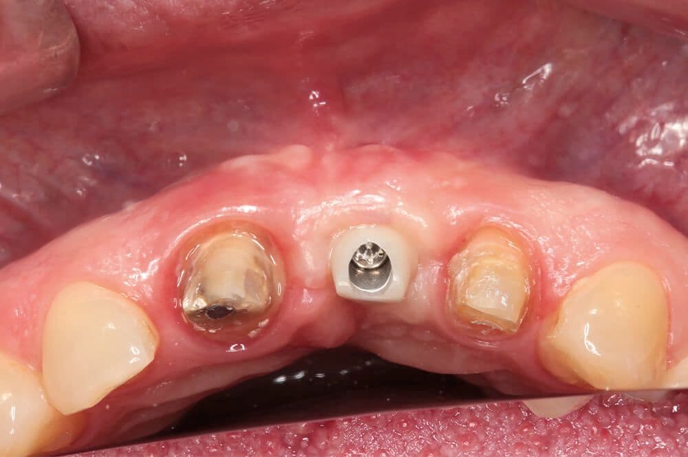 Abb 1: Ausgangssituation, Zahn 12 vor endodontischer Behandlung.