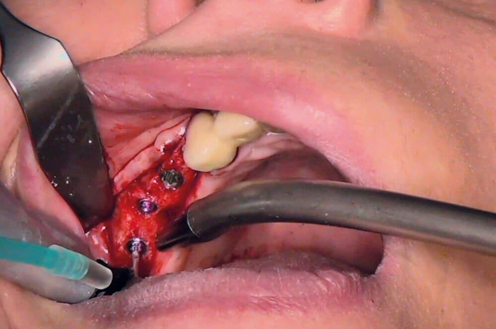 Ultrakurze Implantate im Molarenbereich