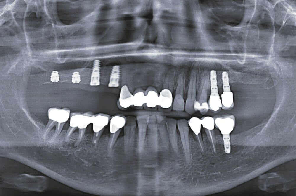 Ultrakurze Implantate im Molarenbereich