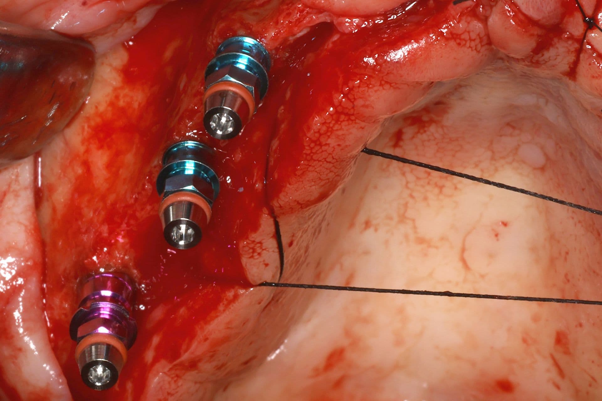 Abbildung 19: Einsetzen von Implantaten mit 2,5 mm Durchmesser, gefolgt von einer Überkorrektur der Kieferkammbreite mit autologem Knochen, der durch Knochenpräparation gewonnen wurde (hauptsächlich aus dem Einsetzen von Implantaten im Unterkiefer), kombiniert mit PRGF-Endoret und einer dünnen Schicht Biomaterial (bovines Hydroxylapatit), das ebenfalls mit PRGF-Endoret eingebracht wurde.