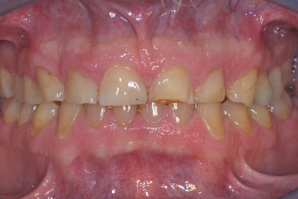 Cerec-Tag