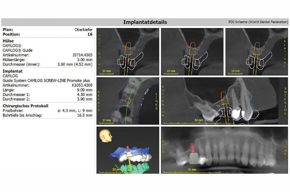 Abb 5: Auf Basis der DVT-Aufnahme und intraoralen Scans erfolgte die 3D-Implantatplanung.