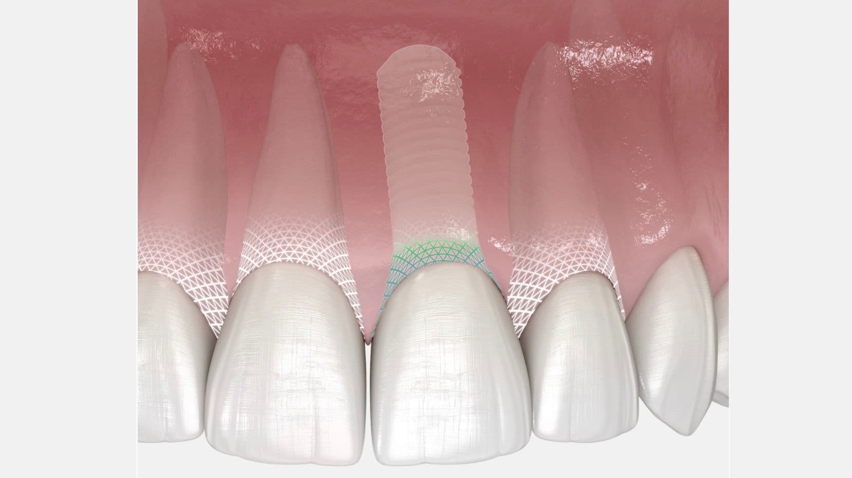 Symbionic Teeth