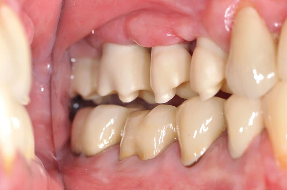 Ultrakurze Implantate im Molarenbereich