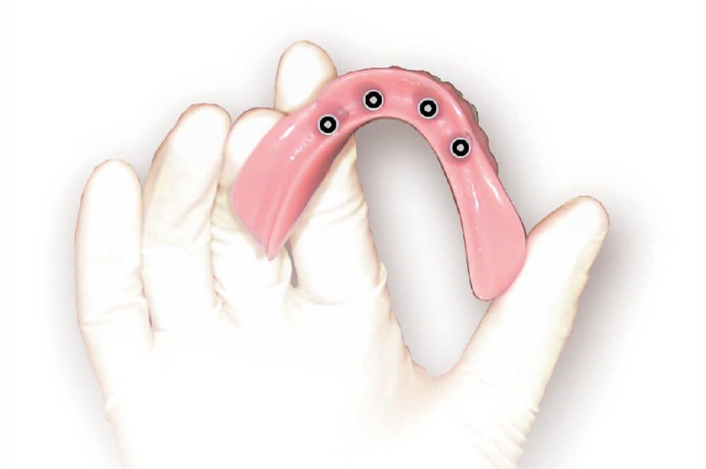 Mini-Implantate