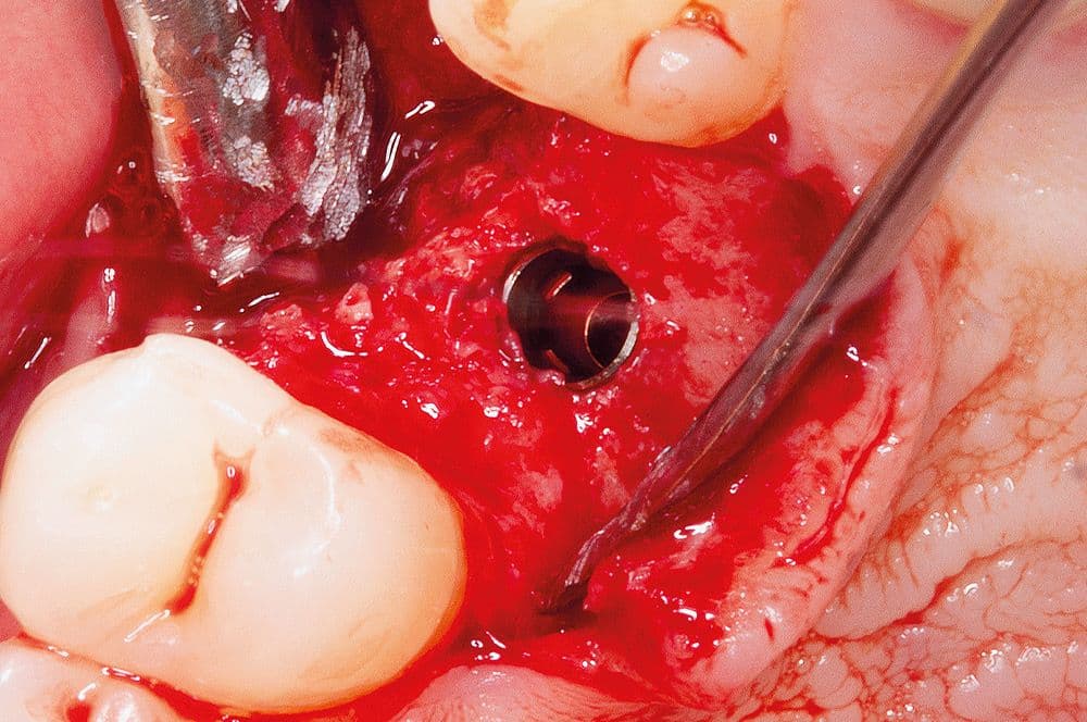 Re-Entry nach vier Monaten. Ausreichend wiederhergestellter Alveolarkamm mit einer vollständigen Integration des Augmentats