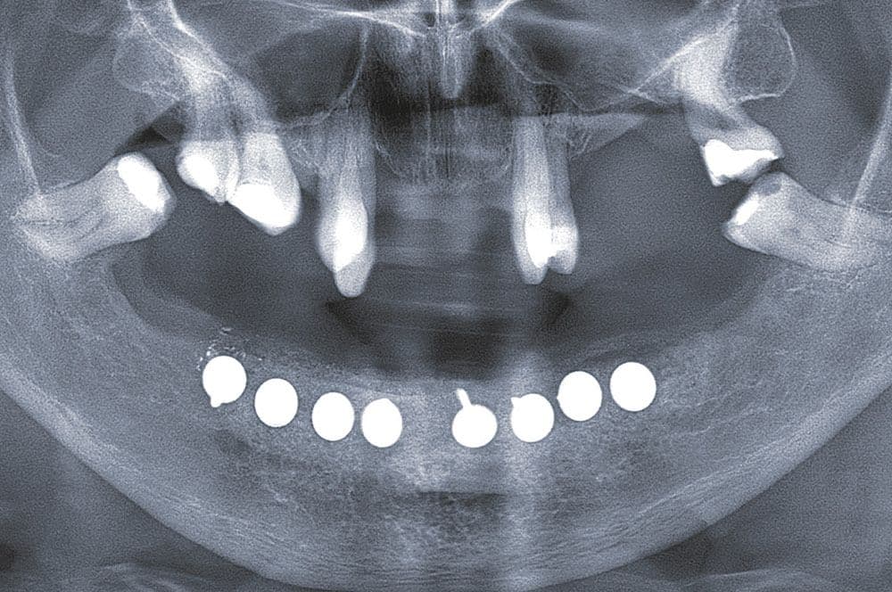 Planung von acht Schirmschrauben (Vertrieb: Geistlich Biomaterials) zur Unterstützung der Augmentation.