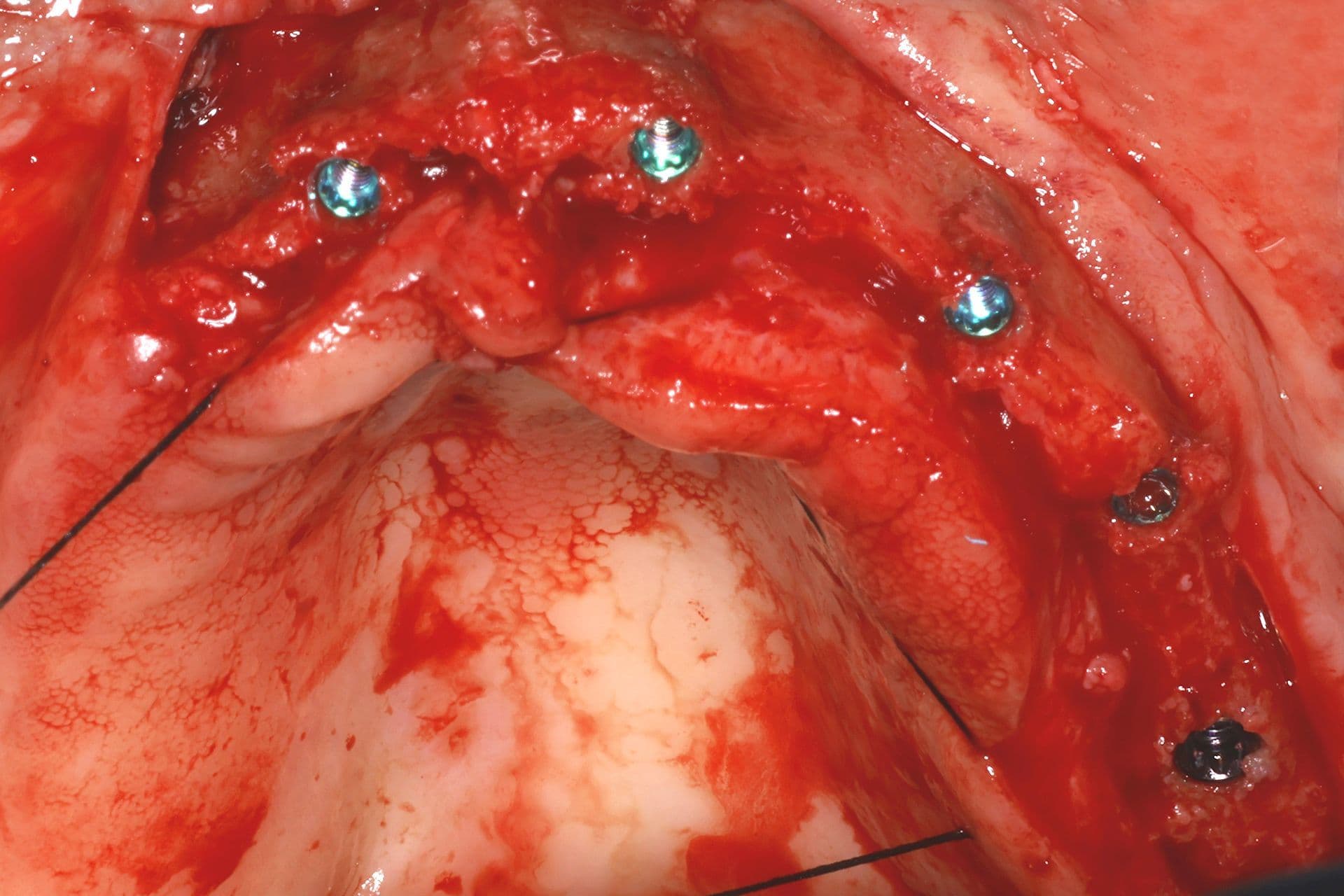 Abbildung 16: Einsetzen von Implantaten mit 2,5 mm Durchmesser, gefolgt von einer Überkorrektur der Kieferkammbreite mit autologem Knochen, der durch Knochenpräparation gewonnen wurde (hauptsächlich aus dem Einsetzen von Implantaten im Unterkiefer), kombiniert mit PRGF-Endoret und einer dünnen Schicht Biomaterial (bovines Hydroxylapatit), das ebenfalls mit PRGF-Endoret eingebracht wurde.