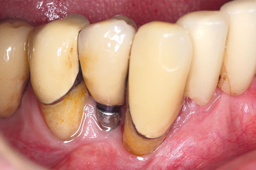 1. Intraorales Foto des Implantates regio 44.