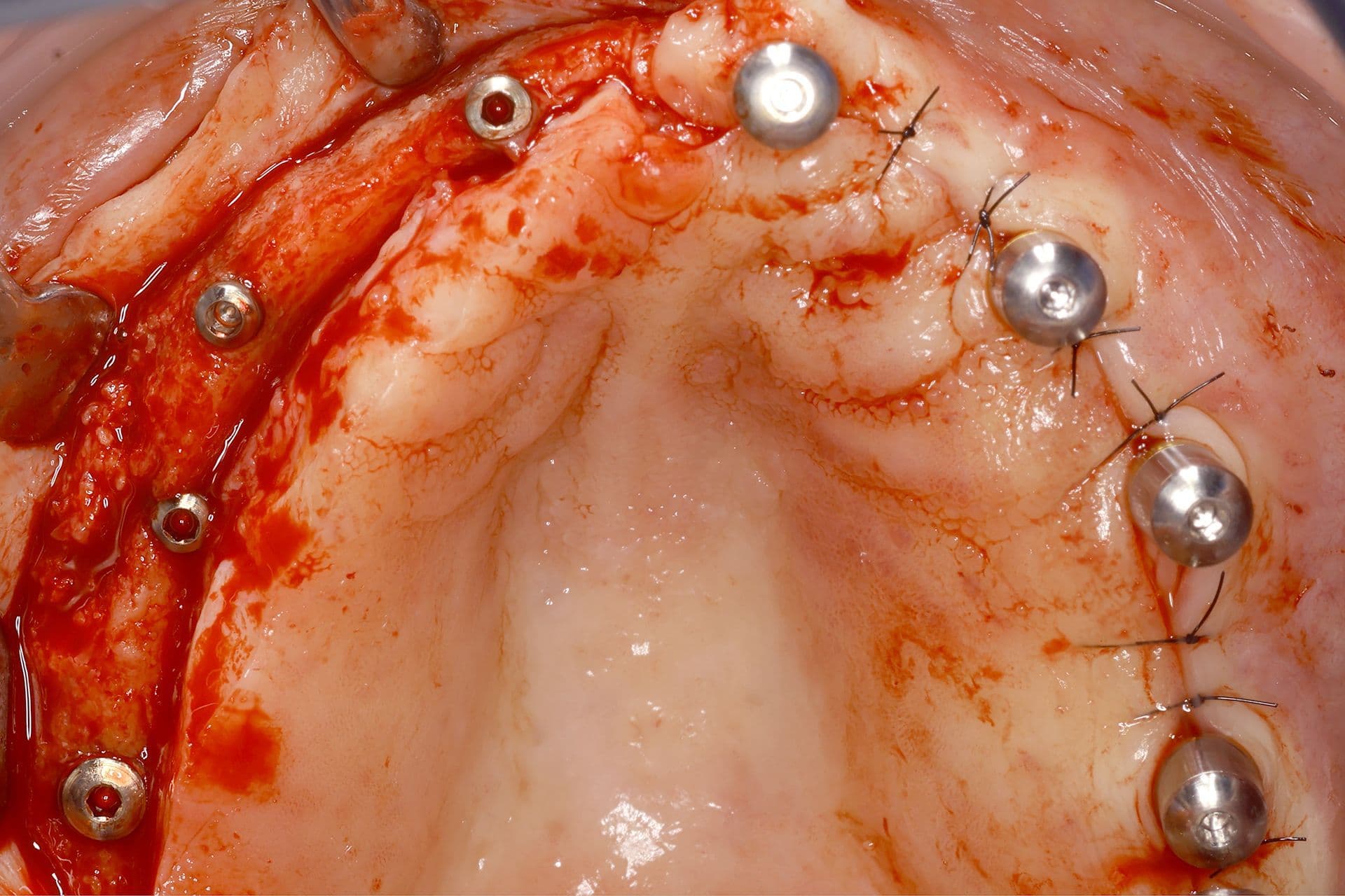 Abbildung 26: Zweiter Eingriff, bei dem der hervorragende Zustand der Implantate und die durch die vorgenommene bukkale Überkorrektur gewonnene Breite zu erkennen sind. Gleichzeitig ist eine Verdickung des den Kieferkamm bedeckenden Weichgewebes erkennbar.