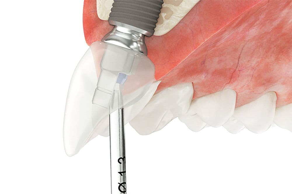 3D-Illustration eines Implantats im Unterkiefer mit eingesetztem CAD/CAM-Instrument