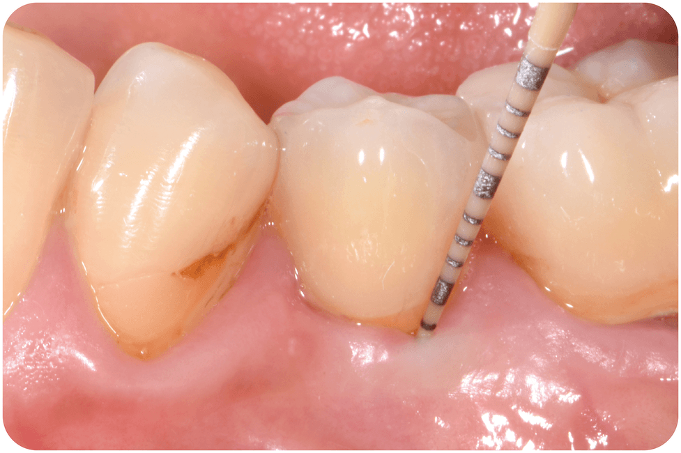Zero Periimplantitis