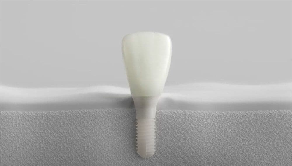 Patent-Implantatsystem