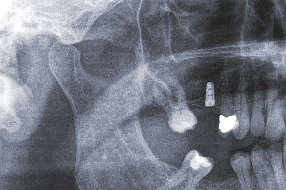 Abb 11: Das KEM wurde von distal eingebracht, um periimplantär ausreichend Knochen für das Implantat zu erhalten.