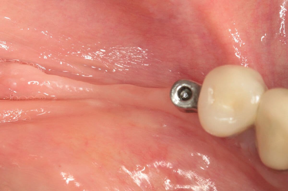 Schirmschraube Augmentation 3. Quadrant Ausgangssituation