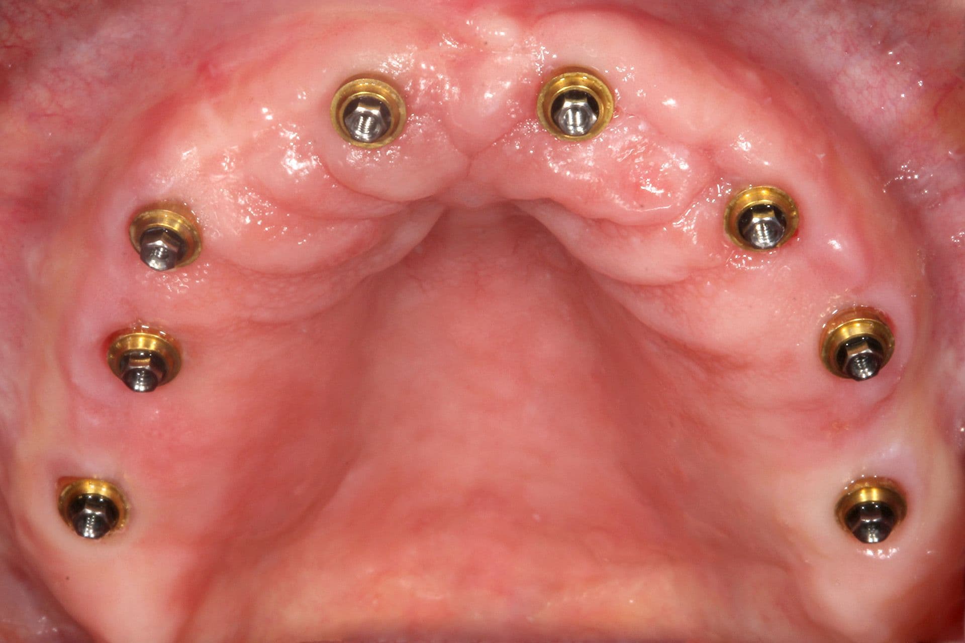 Abbildung 33: Das periimplantäre Weichgewebe zum Zeitpunkt der Abformung für die definitive Versorgung.
