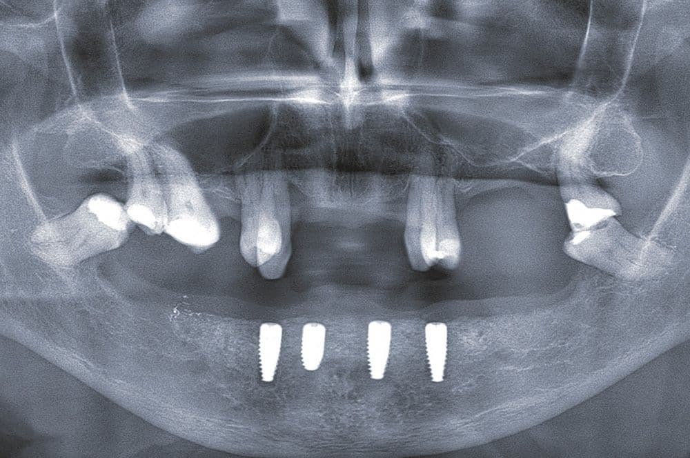 Deutlicher Volumengewinn im Unterkiefer und für eine implantatprothetische Versorgung gut osseointegrierte Implantate.