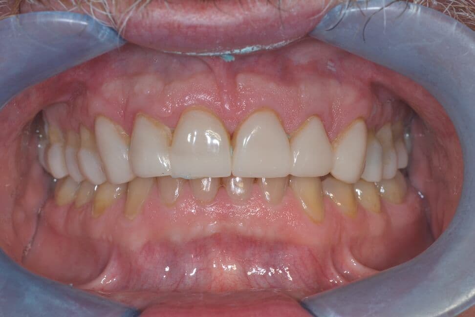 Cerec-Tag