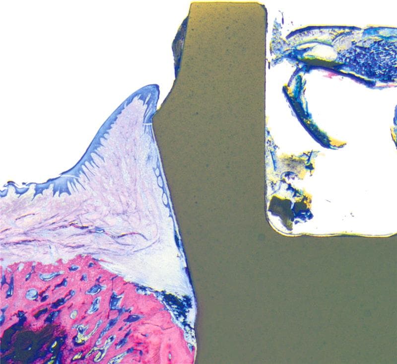 Periimplantitis