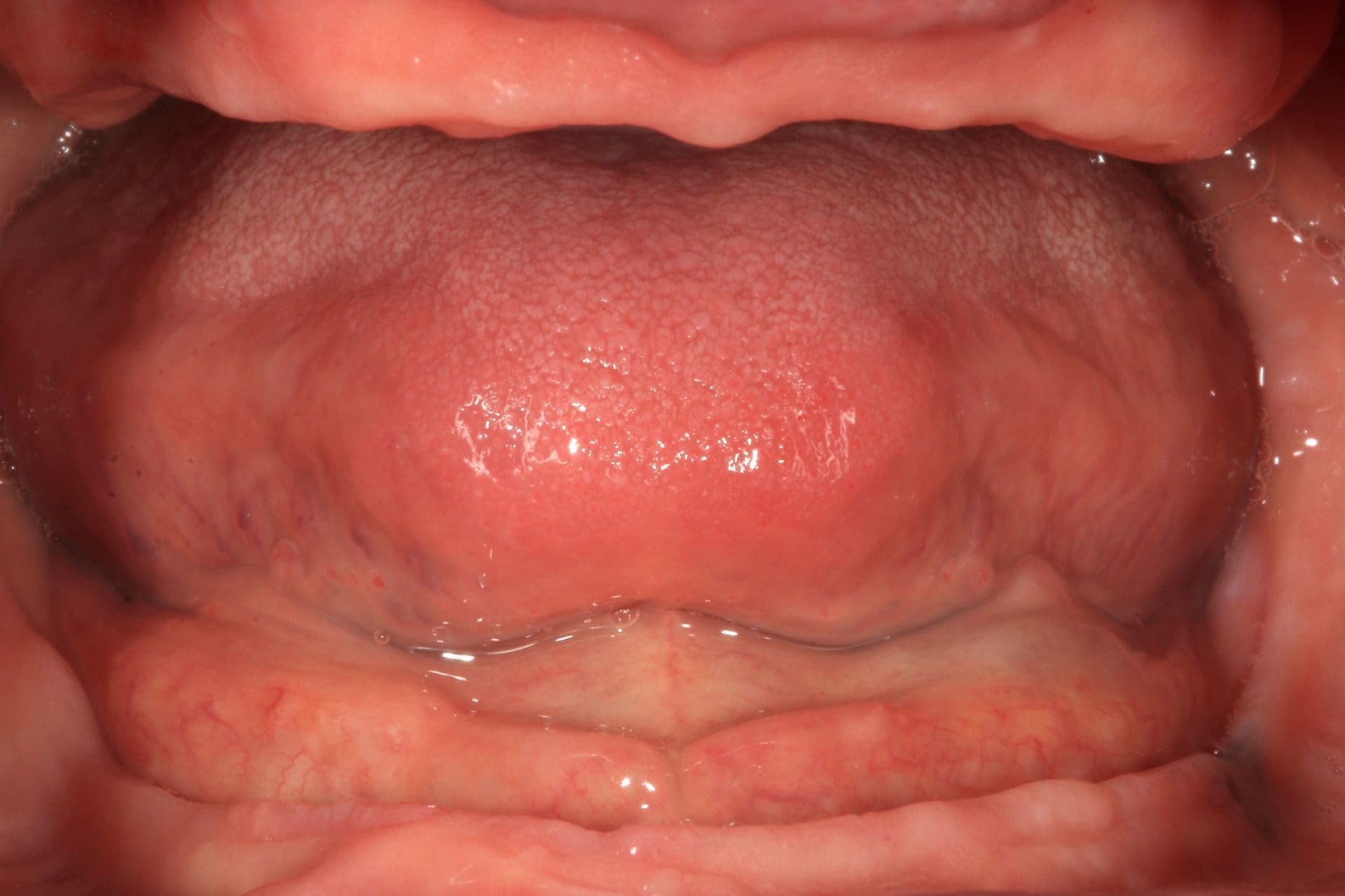 Abbildung 1: Auf den intraoralen Aufnahmen ist ein großer, zu versorgender interokklusaler Raum zu erkennen, was auf eine begleitende vertikale Atrophie hindeutet, sowie dünne Alveolarkämme, die von atrophischer Schleimhaut bedeckt sind, insbesondere im Unterkiefer, was auf eine zugrunde liegende horizontale Atrophie schließen lässt.