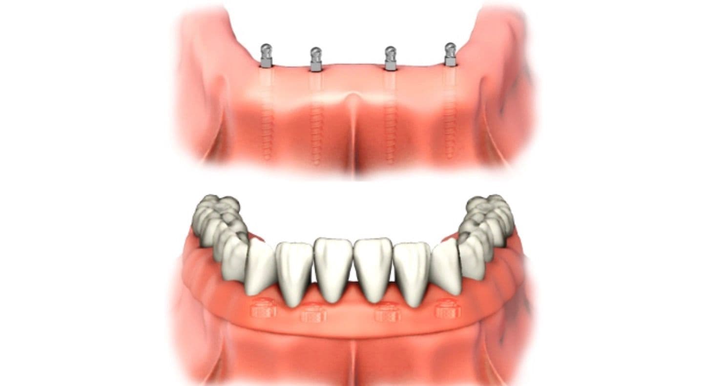Mini-Implantate