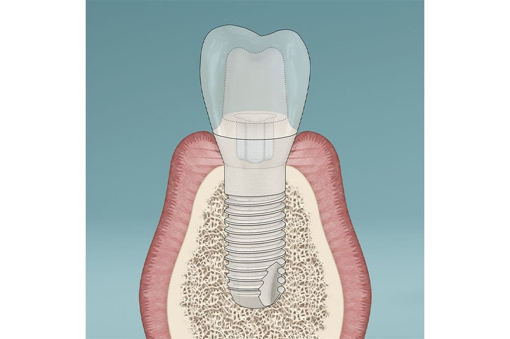 Periimplantitis