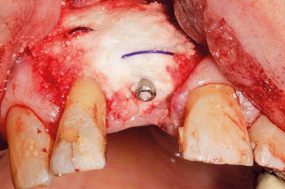 In Kombination mit modernen regenerativen Materialien wie EthOss unterstützt der Faden die Guided Bone Regeneration.