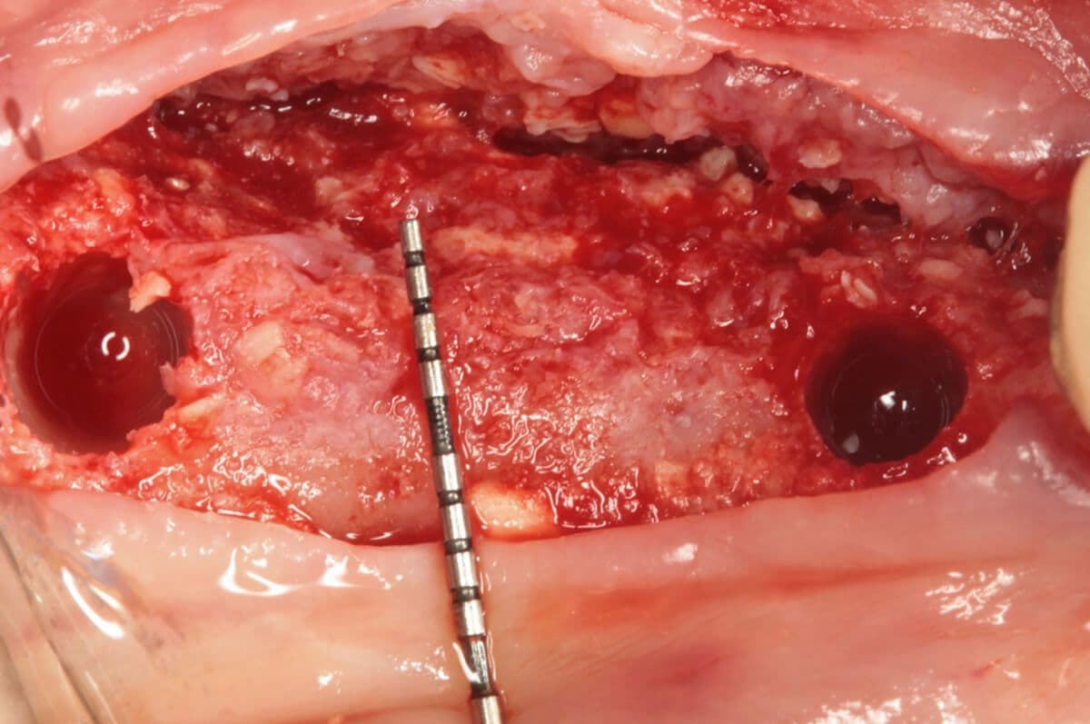 neu_Nach Bohrung für die Implantate Durchmesser 4,1 mm
