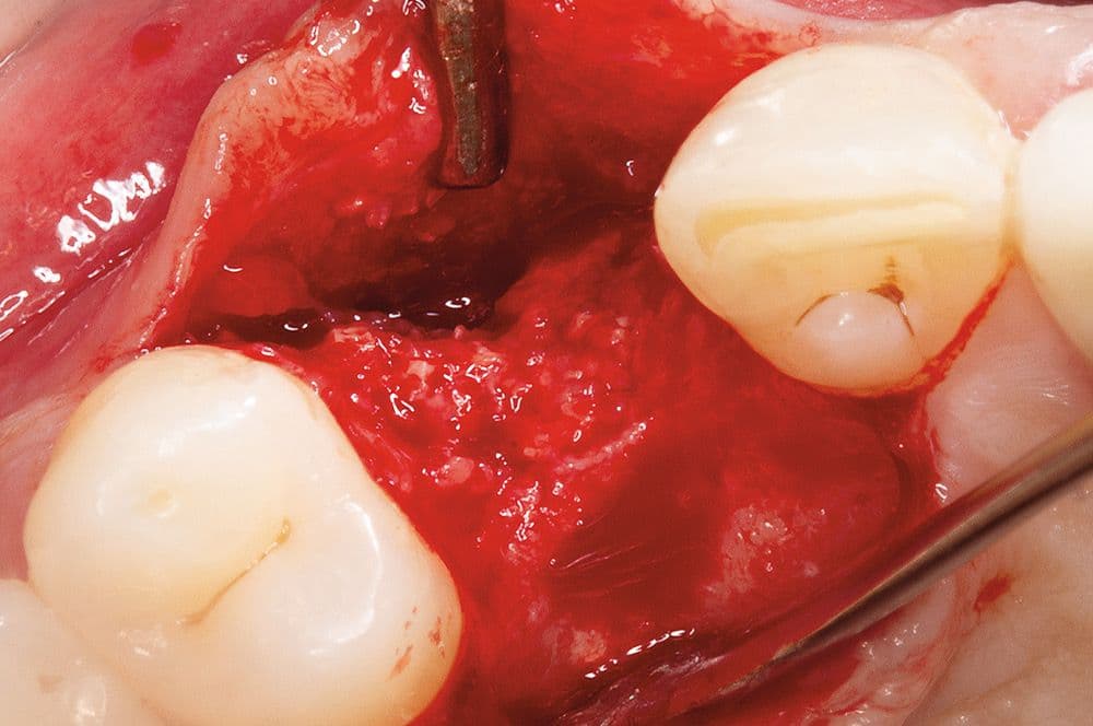Das ehemalige Augmentat wies die Eigenschaften vitalen Knochens auf