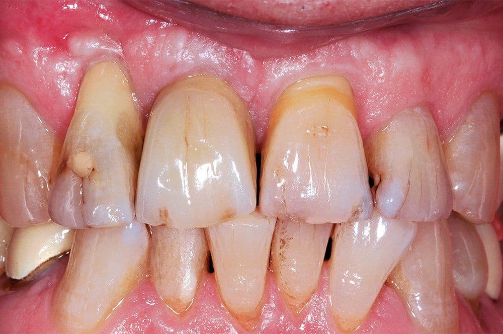 Harmonische Gesamterscheinung bei stabil eingeheiltem Implantat.
