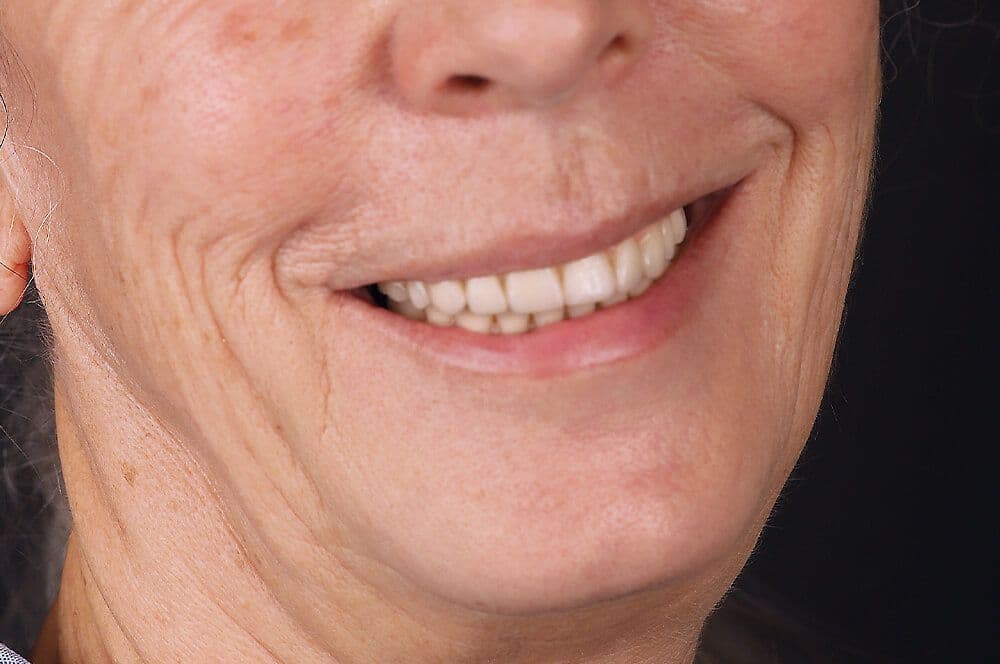 Abb 1: Implantatprothetische Versorgung nach dem All-on-4-Prinzip.