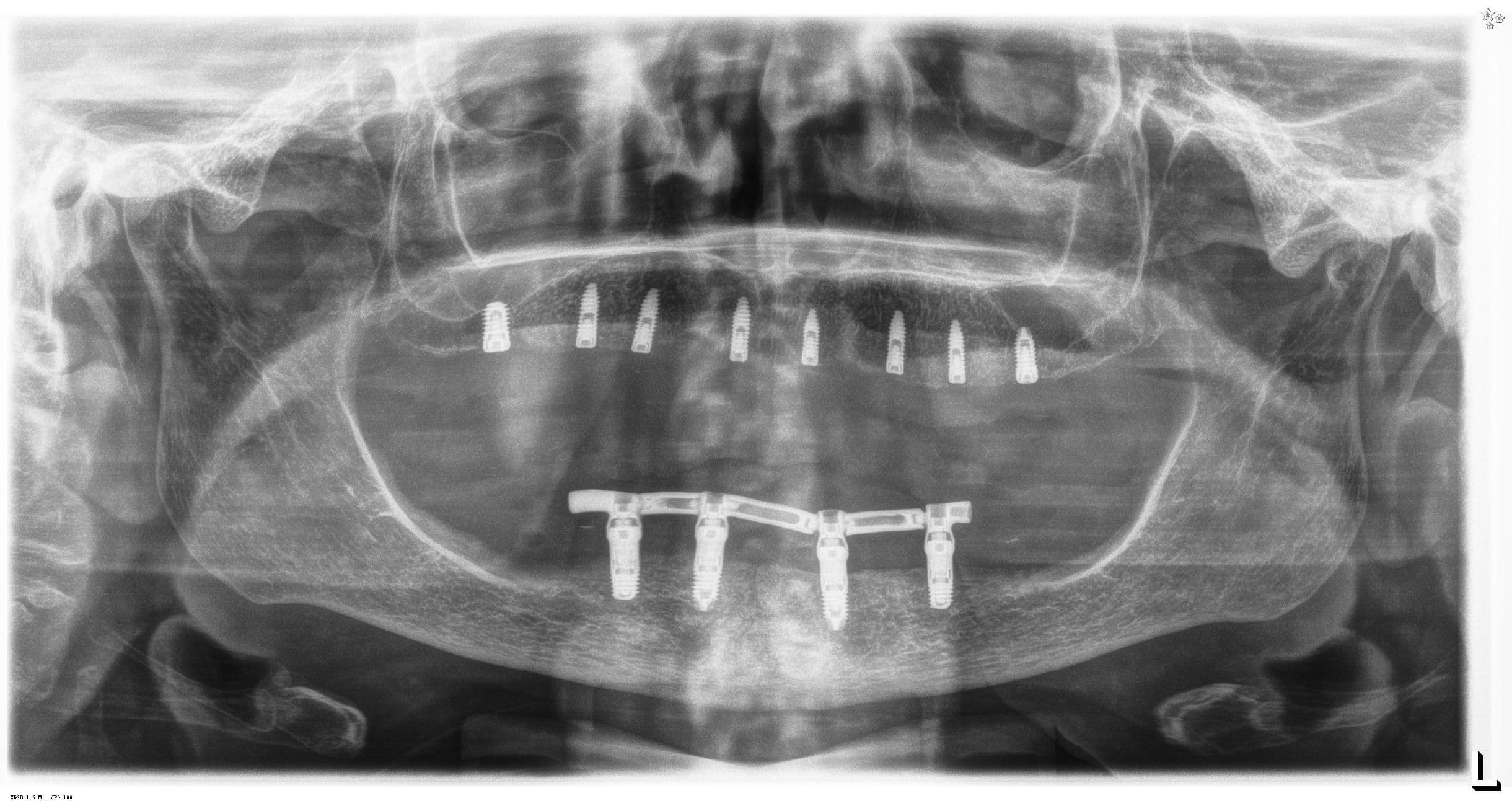 Abbildung 24: Einsetzen des Provisoriums im UK und OK nach dem Einsetzen der Implantate.