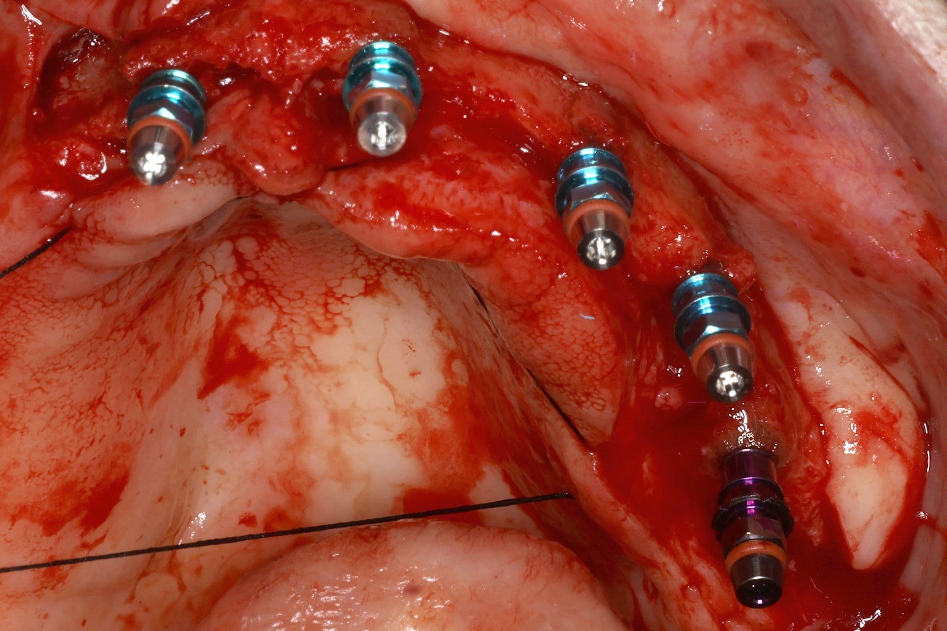Abbildung 15: Einsetzen von Implantaten mit 2,5 mm Durchmesser, gefolgt von einer Überkorrektur der Kieferkammbreite mit autologem Knochen, der durch Knochenpräparation gewonnen wurde (hauptsächlich aus dem Einsetzen von Implantaten im Unterkiefer), kombiniert mit PRGF-Endoret und einer dünnen Schicht Biomaterial (bovines Hydroxylapatit), das ebenfalls mit PRGF-Endoret eingebracht wurde.