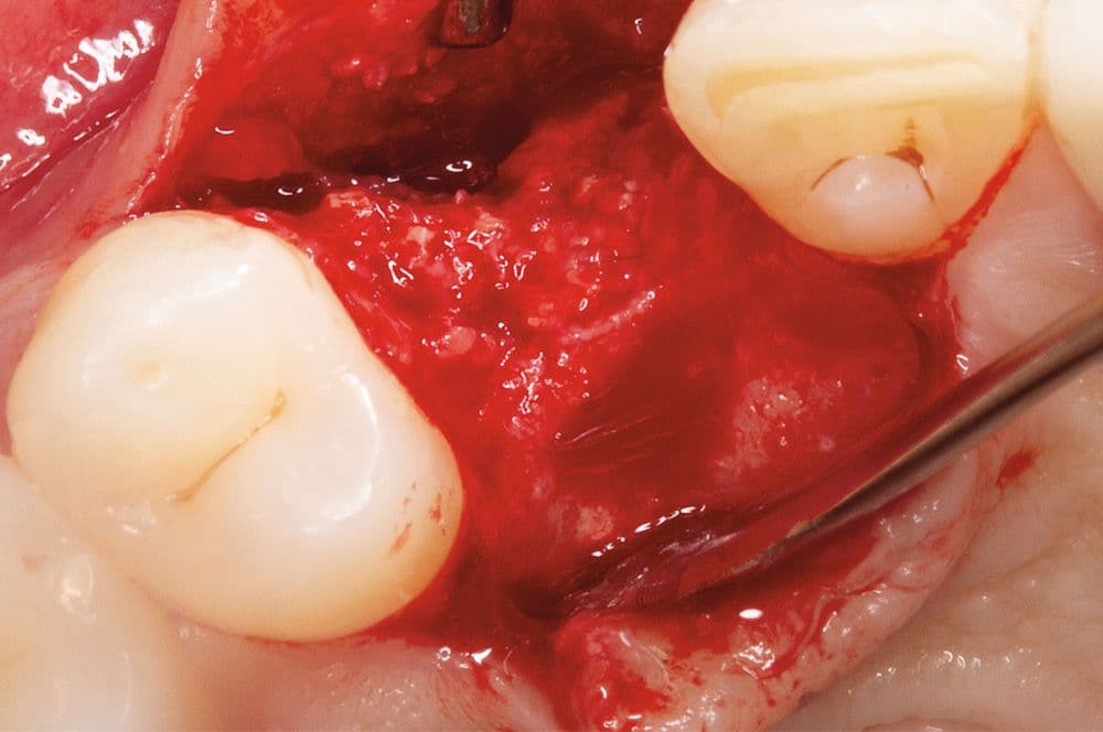 Das ehemalige Augmentat wies die Eigenschaften vitalen Knochens auf.