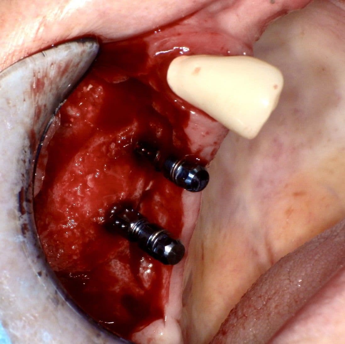 Implantation vier Monate nach Augmentation unter Verwendung von Straumann® BLT Implantaten.