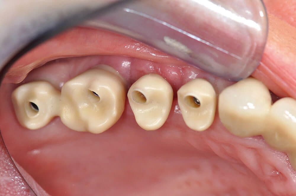 Ultrakurze Implantate im Molarenbereich