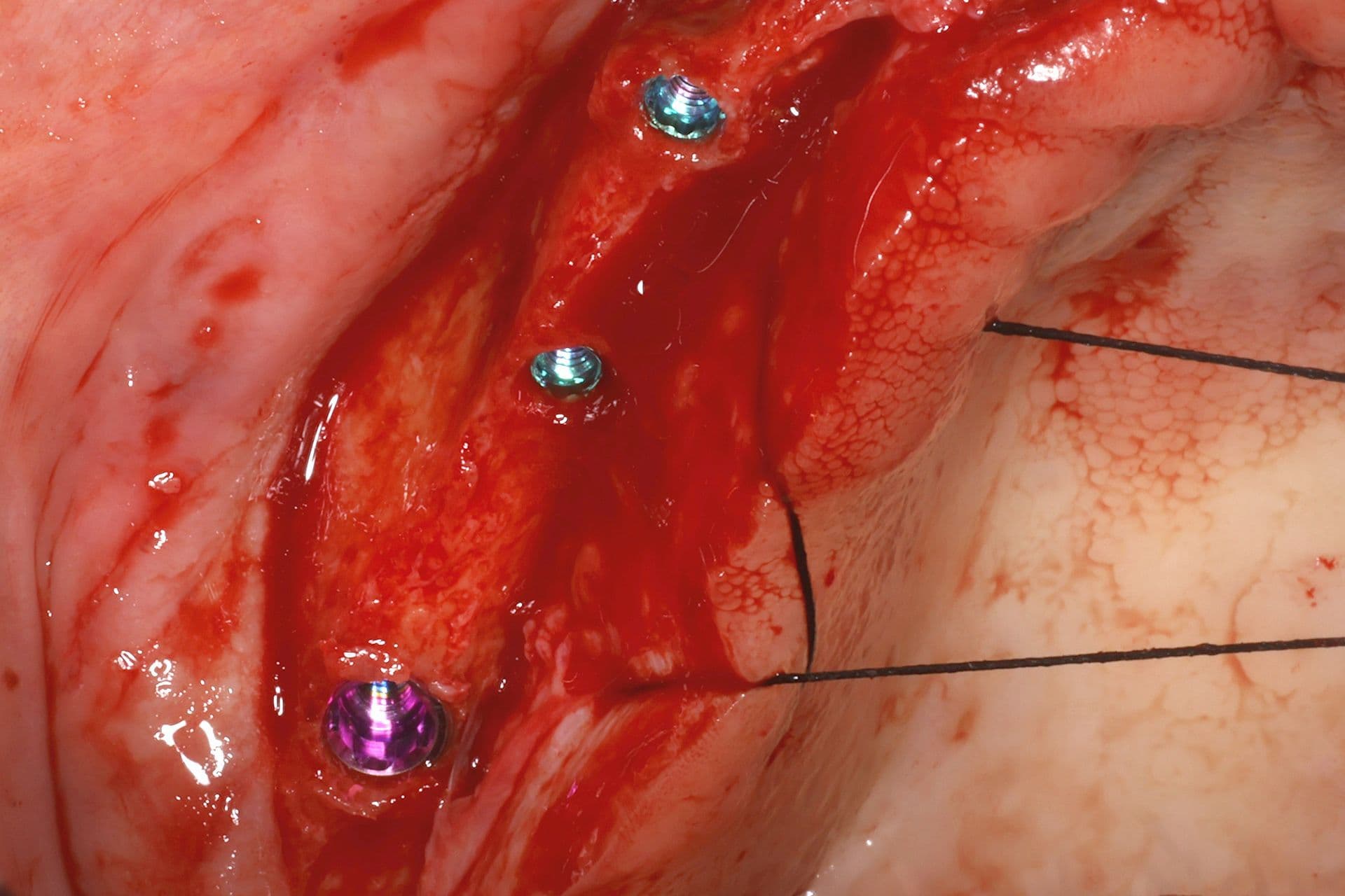 Abbildung 20: Einsetzen von Implantaten mit 2,5 mm Durchmesser, gefolgt von einer Überkorrektur der Kieferkammbreite mit autologem Knochen, der durch Knochenpräparation gewonnen wurde (hauptsächlich aus dem Einsetzen von Implantaten im Unterkiefer), kombiniert mit PRGF-Endoret und einer dünnen Schicht Biomaterial (bovines Hydroxylapatit), das ebenfalls mit PRGF-Endoret eingebracht wurde.