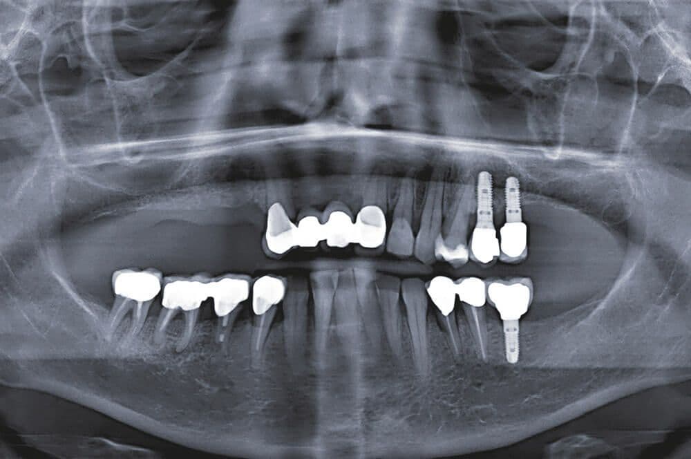 Ultrakurze Implantate im Molarenbereich