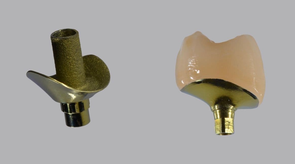 Abutment