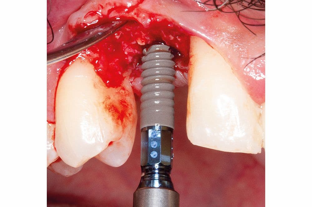 Bei der Präparation eines Implantatbettes zeigte sich eine hohe Stabilität und gesunde Durchblutung