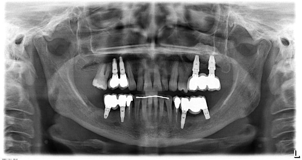 Kieferkammspreizung bei extremer Knochenatrophie_11