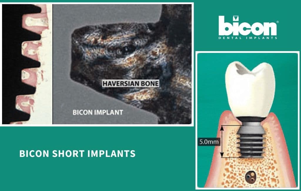 Implantatlänge