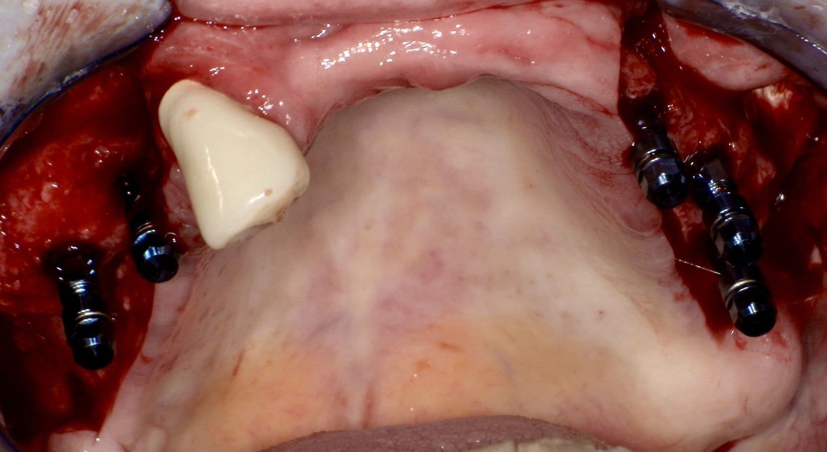 Implantation vier Monate nach Augmentation unter Verwendung von Straumann® BLT Implantaten.